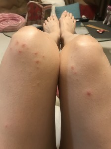 足の湿疹624
