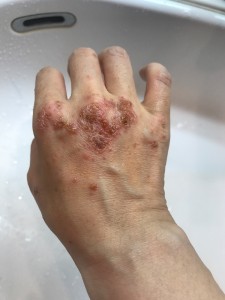 手の湿疹3(右手)-2020年7月7日