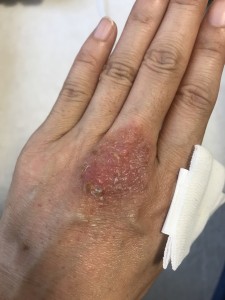 手の湿疹1-2019年10月