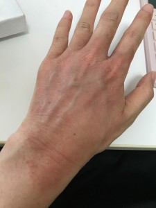 手の湿疹7(左手)-2020年8月6日