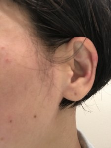玄米断食7日後の耳の湿疹湿疹