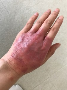 手の湿疹6-2020年7月19日