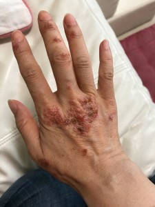 手の湿疹4(右手)-2020年7月13日