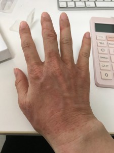手の湿疹7(右手)-2020年8月6日