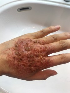 手の湿疹3(左手)-2020年7月7日