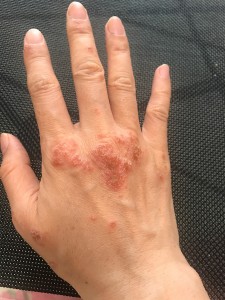手の湿疹2(右手)-2020年7月4日